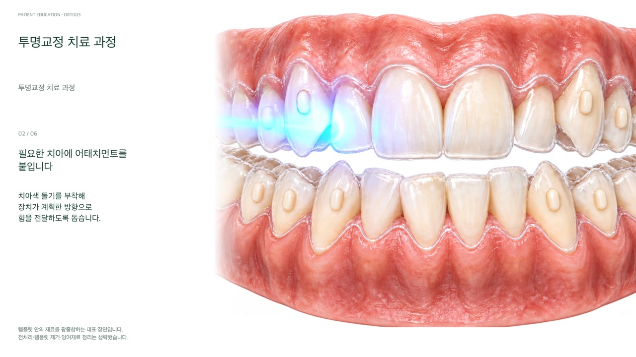 Educational illustration: General clear aligner treatment